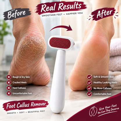 Foot Callus Remover